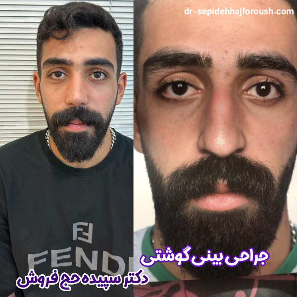 جراحی بینی گوشتی در ساری - دکتر سپیده حج فروش