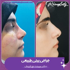 عمل بینی طبیعی - کتر سپیده حج فروش