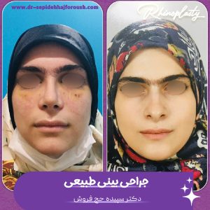 جراحی بینی طبیعی - دکتر سپیده حج فروش