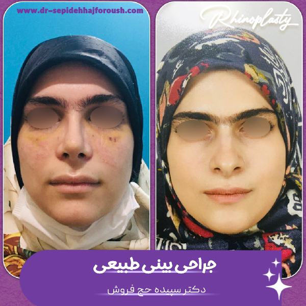جراحی بینی طبیعی - دکتر سپیده حج فروش