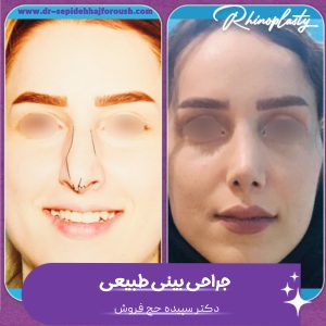جراحی بینی طبیعی - دکتر سپیده حج فروش