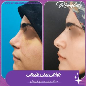 جراحی بینی نچرال در ساری - دکتر حج فروش
