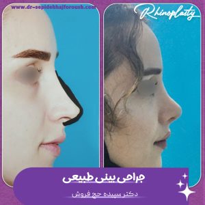 عمل بینی طبیعی در ساری - دکتر حج فروش