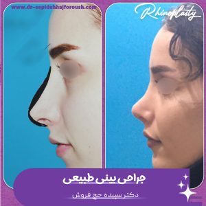 جراحی بینی طبیعی در ساری - دکتر حج فروش