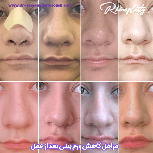 ورم بینی بعد از عمل - دکتر سپیده حج فروش