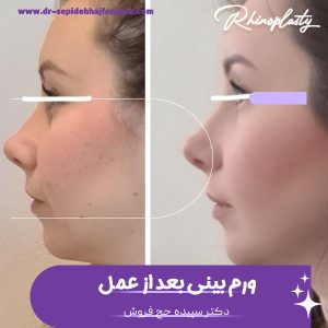 ورم بینی بعد از عمل - دکتر سپیده حج فروش