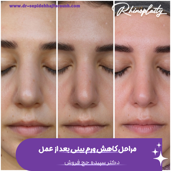 ورم بینی بعد از عمل - دکتر سپیده حج فروش