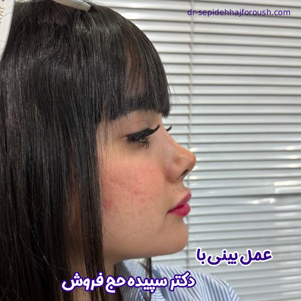 جراحی بینی - دکتر سپیده حج فروش