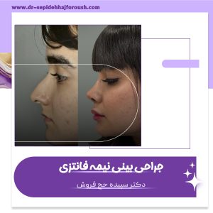 جراحی بینی نیمه فانتزی - دکتر سپیده حج فروش