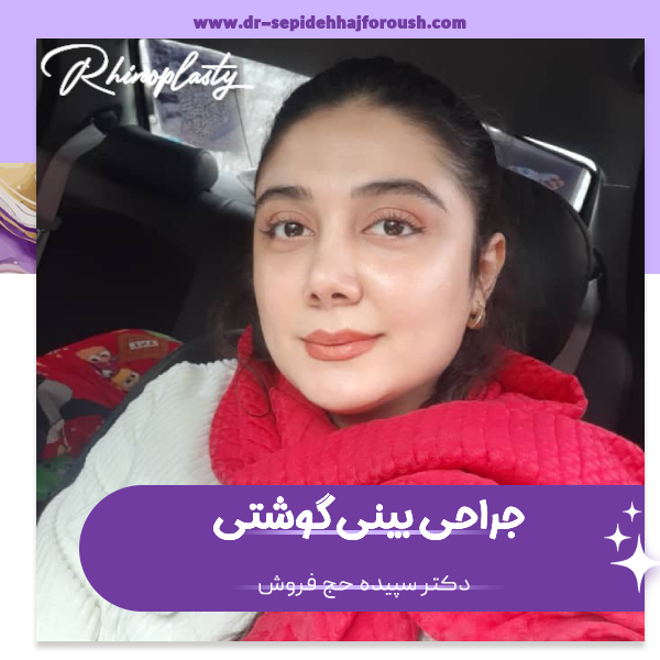 عمل بینی گوشتی در ساری - دکتر سپیده حج فروش