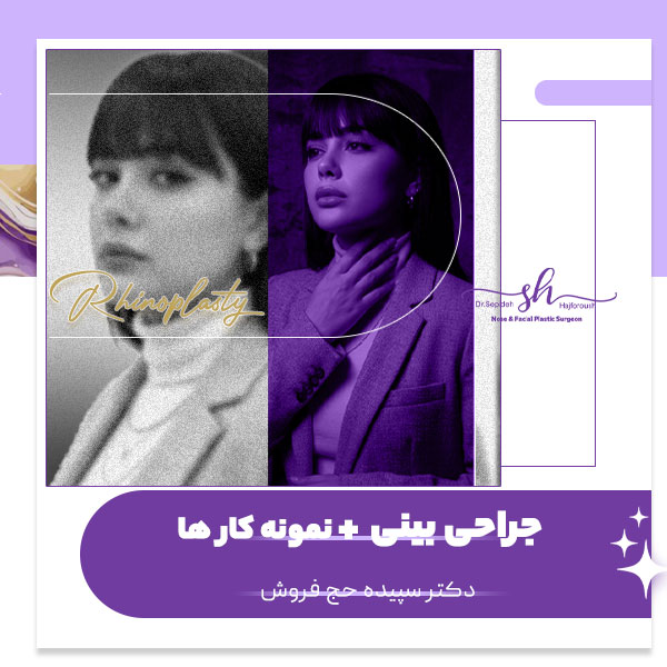 جراحی بینی - دکتر سپیده حج فروش
